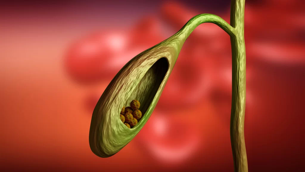 Cálculos Biliares (Colecistitis Aguda)